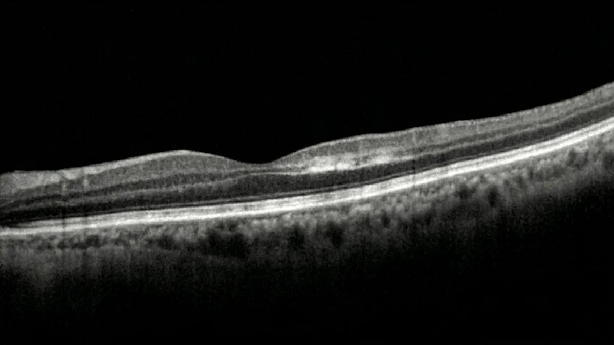 旁中心急性中层黄斑病变：诊断与治疗管理