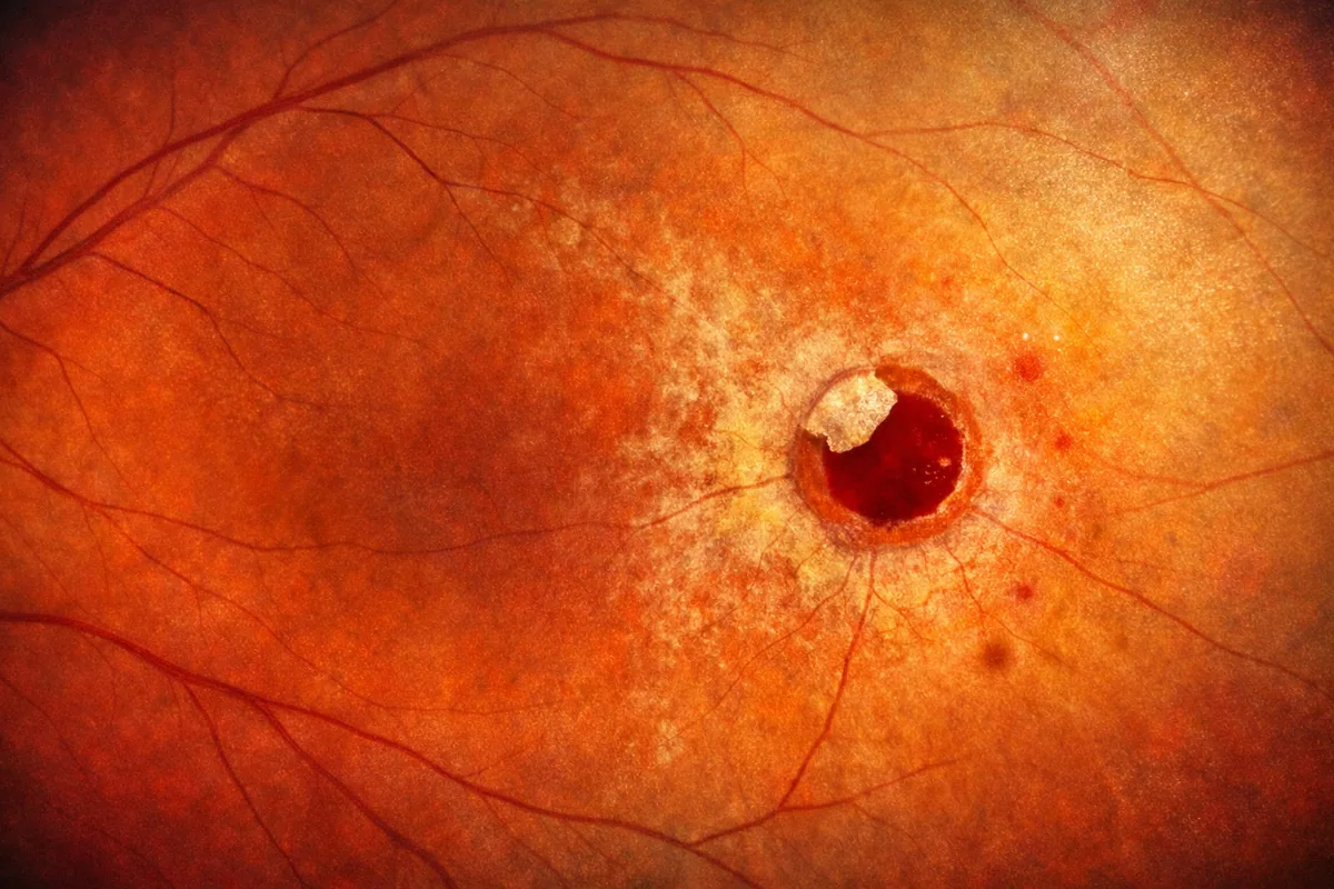 Trou operculé rétinien