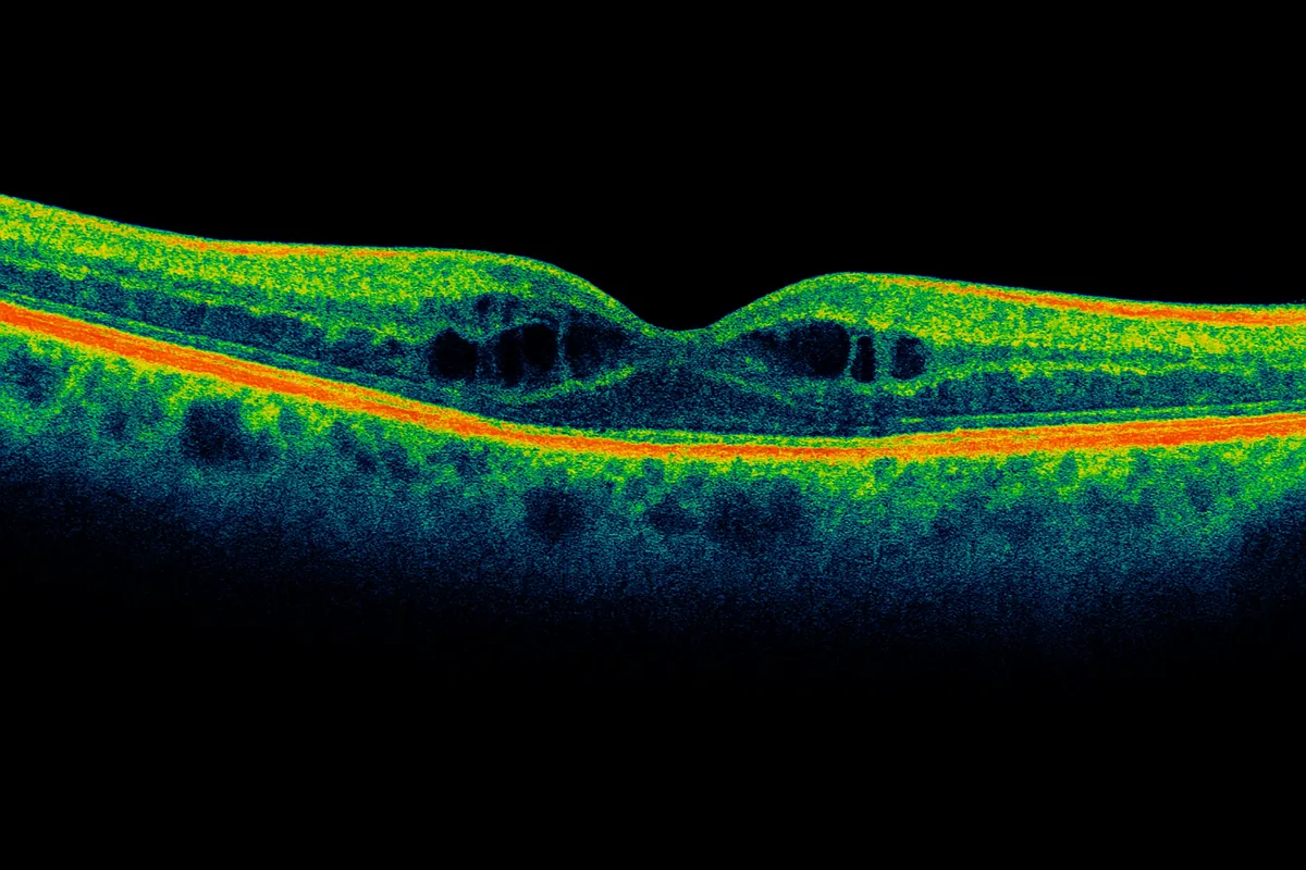 Oedème maculaire diabétique