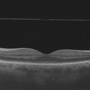 Décollement postérieur du vitré