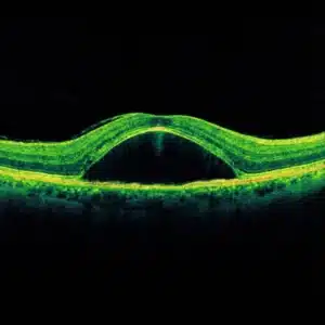 Choriorétinite séreuse centrale