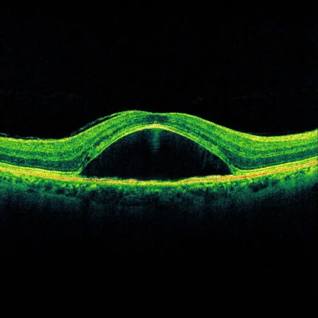 choriorétinite séreuse centrale ou crsc