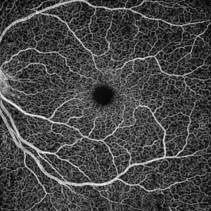 DMLA et OCT-angiographie