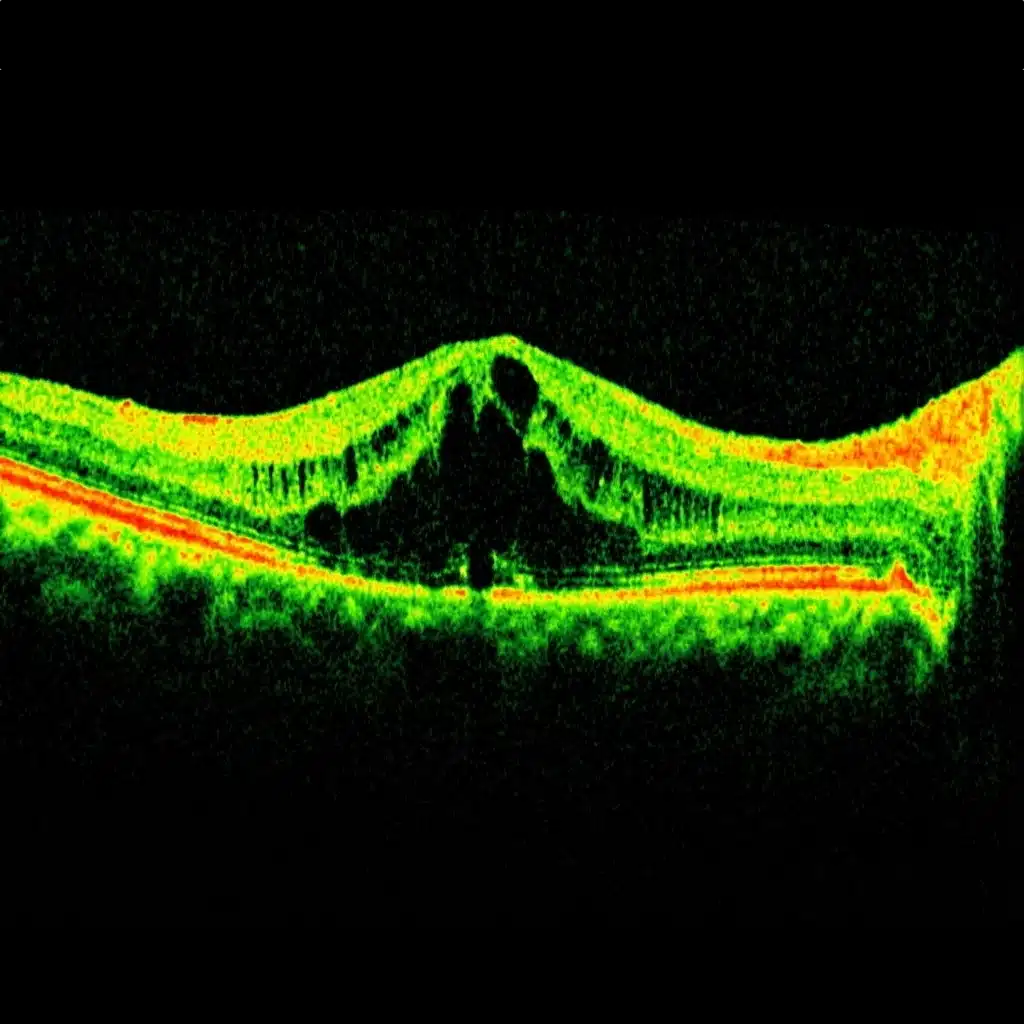 syndrome d'irvine-gass