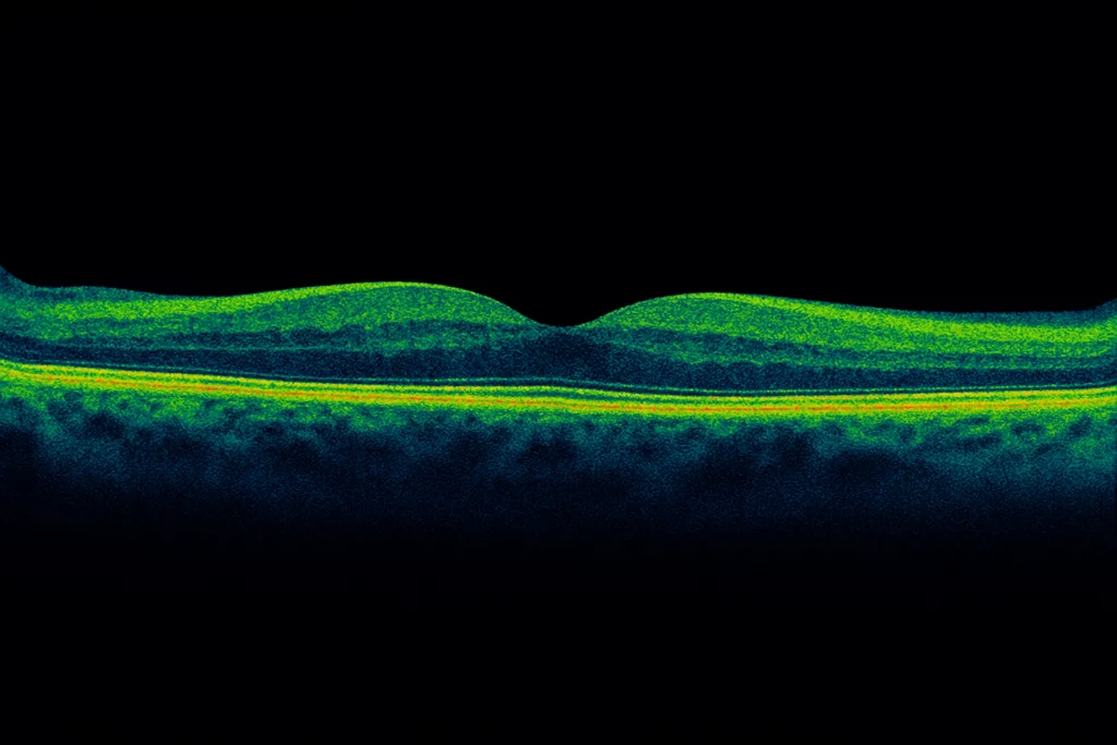 oct ou tomographie en cohérence optique maculaire en couleurs