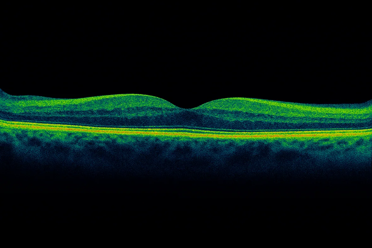 OCT (Tomographie en Cohérence Optique)